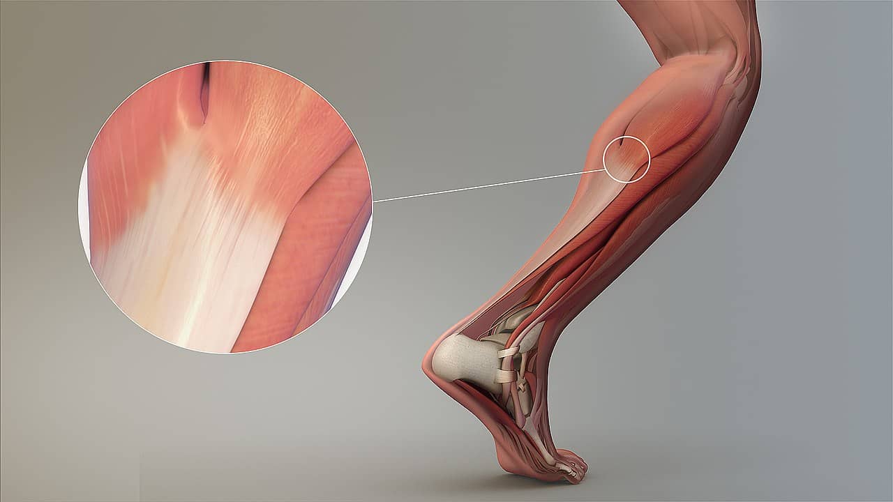 Cómo curar una tendinitis Aquiles Rodilla