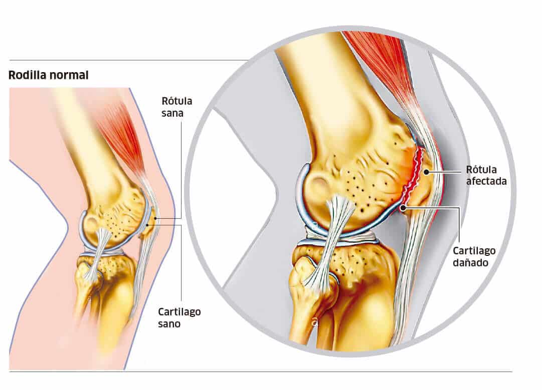 Dolor rodilla Camino de Santiago (1)