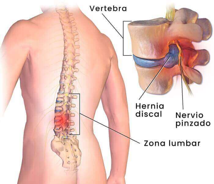 causas dolor de espalda hernia discal