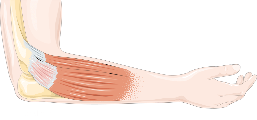 Epicondilitis dolor de codo que hacer