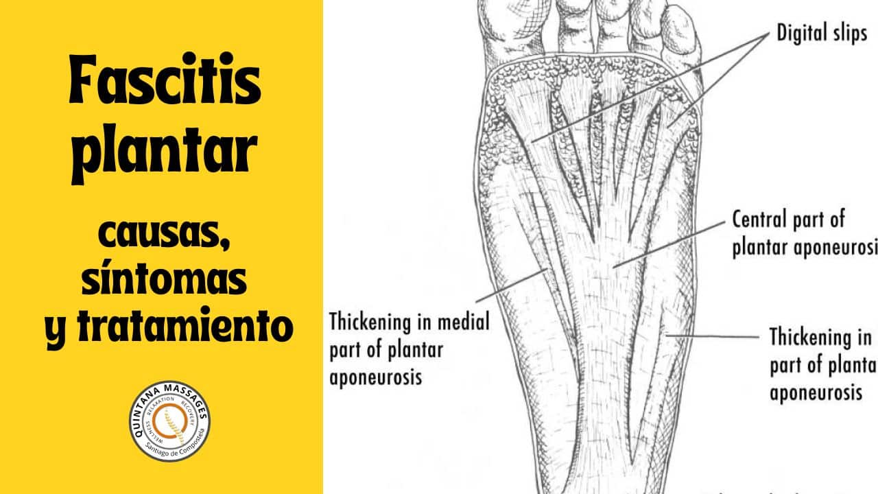 Causas de la fascitis plantar, síntomas y tratamiento del dolor en la planta del pie