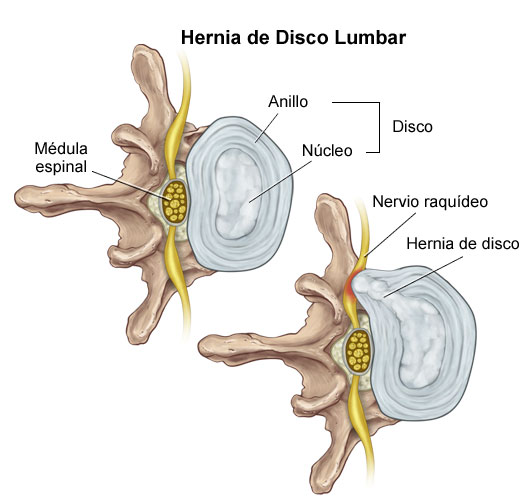 Hernia discal cervical lumbar sintomas tratamiento (1)
