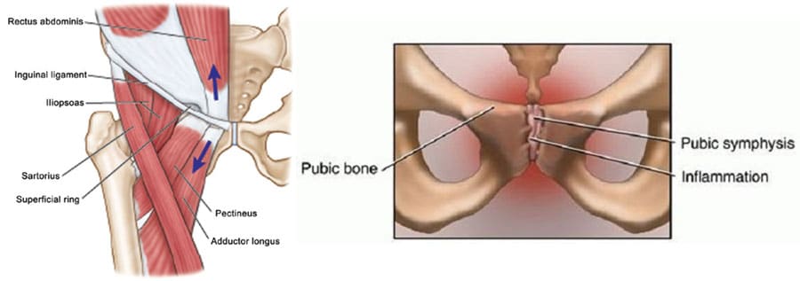 pubalgia osteopatía de pubis