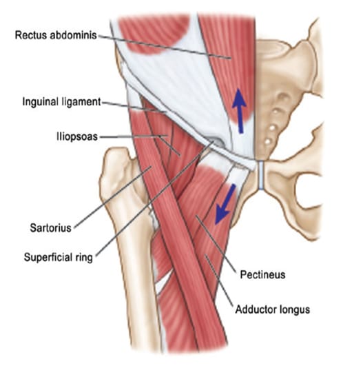 pubalgia síntomas