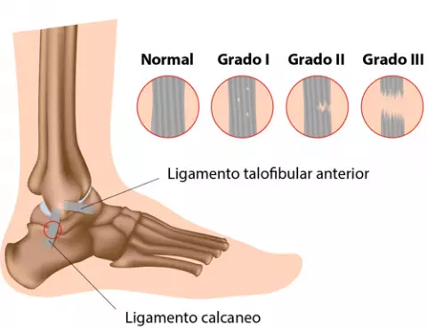 esguice-de-ligamentos-de-tobillo-tratamiento